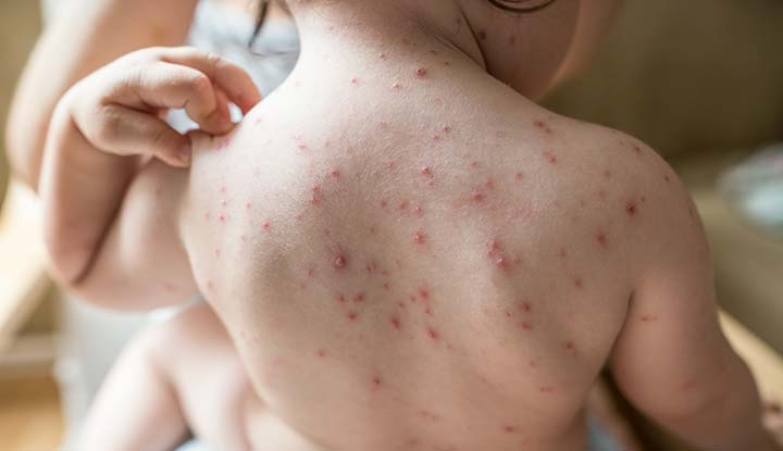 Chicken Pox